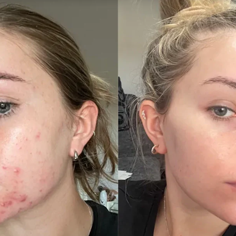 Hydrocolloid Coverage Treatment Roll