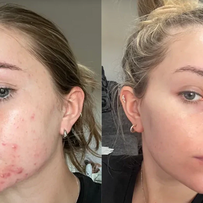 Hydrocolloid Coverage Treatment Roll